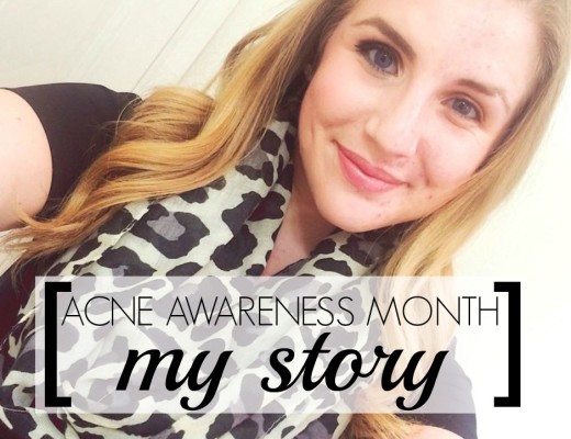Acne Awareness Month my story about dealing with adult acne