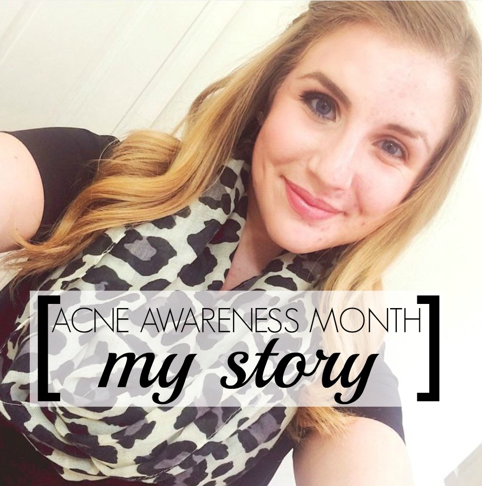 Acne Awareness Month my story about dealing with adult acne