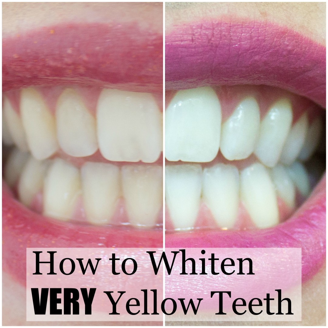 How to whiten very yellow teeth