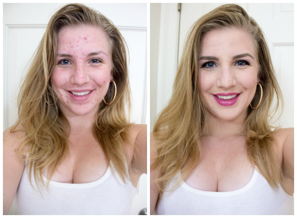 With and without makeup for acne awareness month.